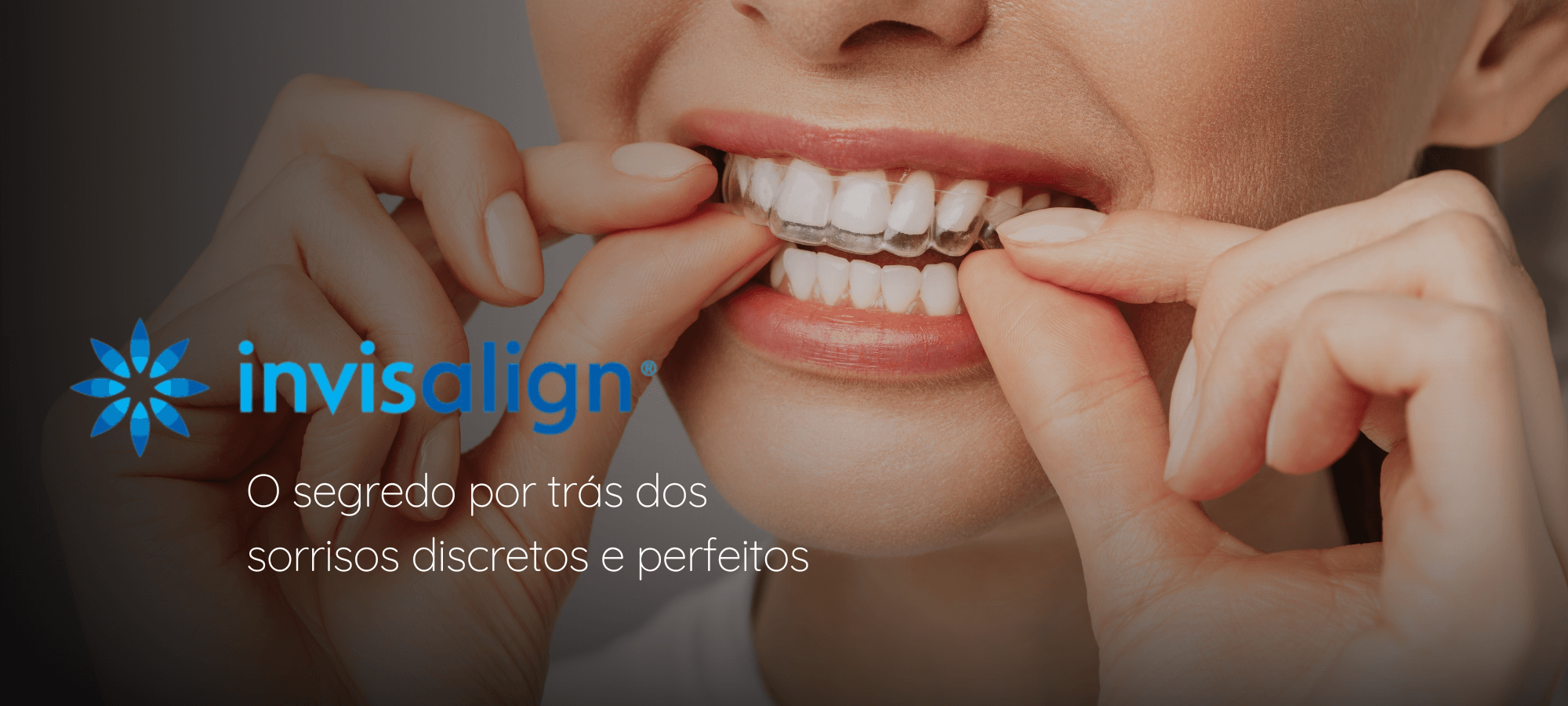 ville-odonto-destaques-invisalign-tiny